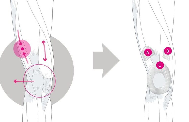 Bolesť v okolí jabĺčka –  Tendinopatia ligamentum patellae 